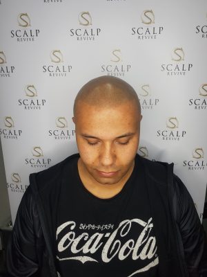 Leeds Hairloss Clinic Scalp micropigmentation in Leeds. UK