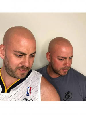 SMP Clinic Leeds. Scalp Micropigmentation Uk