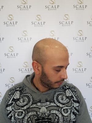 Hair Transplant, scalp micro pigmentation Leeds.