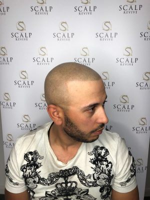 Scalp Micro Leeds