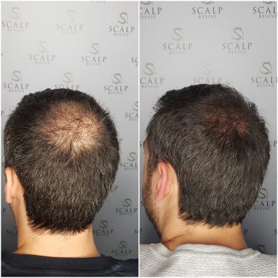 hair tattoo SMP Leeds