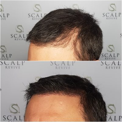 hair transplant smp leeds