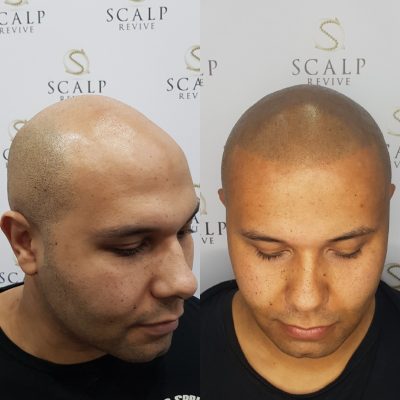 scalp micropigmenation leeds