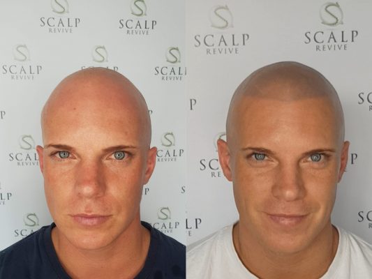 SMP Before and After