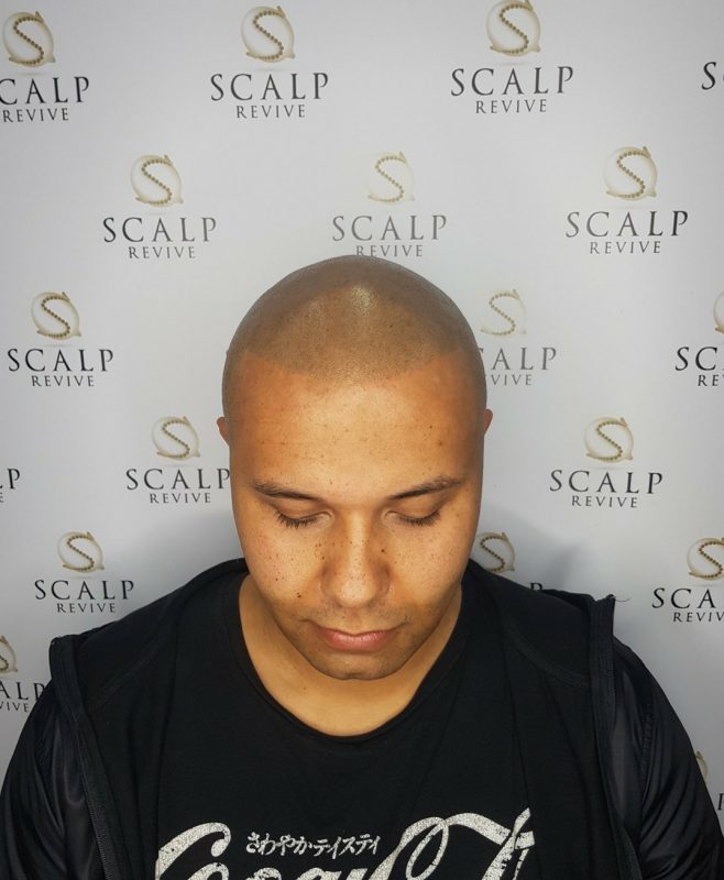 Hair Tattoo Leeds. Scalp micropigmentation in Leeds