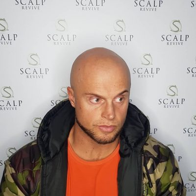 scalp micropigmentation Leeds. hair tattoo Uk. scalp micropigmentation cost.