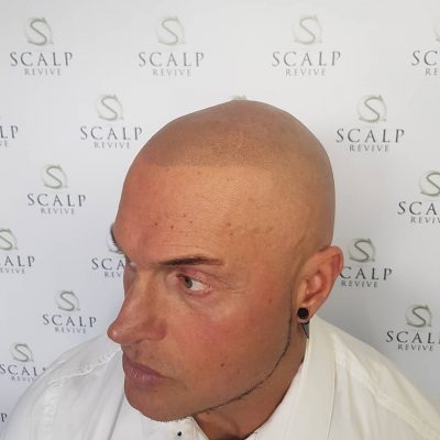 Hair loss Treatment leeds. scalp micropigmentation uk