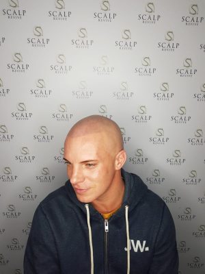 Hair loss treatments Leeds. Uk. scalp micropigmentation in Leeds