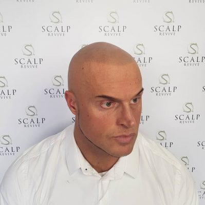 Scalp Revive Leeds. thinning hair treatments leeds