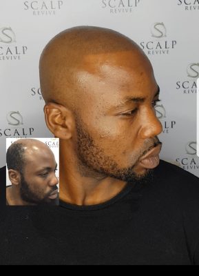 smp leeds hair tattoo. hair loss treatments leeds. skin fade
