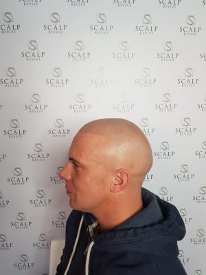 Hair SMP. Leeds scalp micro pigmentation