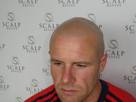 Scalp Micropigmentation Leeds. scalp micropigmentation UK. Hair tattoo in Leeds. Micropigmentation uk.