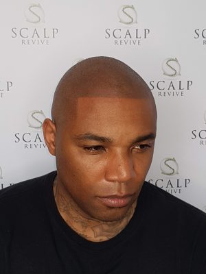 Hair Tattoo Leeds. Scalp Micropigmentation Leeds. Scalp revive