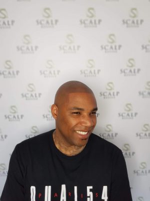 Scalp Micropigmentation Uk. Hair tattoo Leeds.