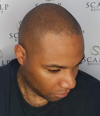 Leeds Scalp Revive. Scalp treatments leeds.