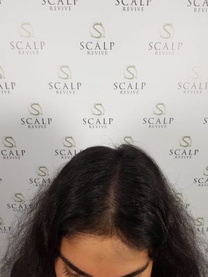 Scalp Micropigmentation for women. SMP for women in Leeds