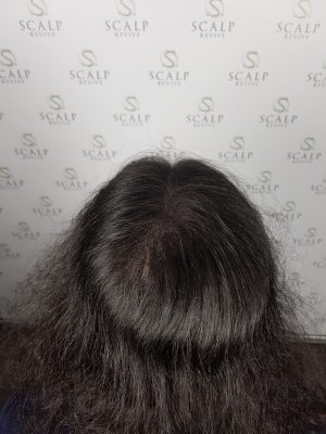 Scalp Micropigmentation for women. hair loss for women. Leeds UK