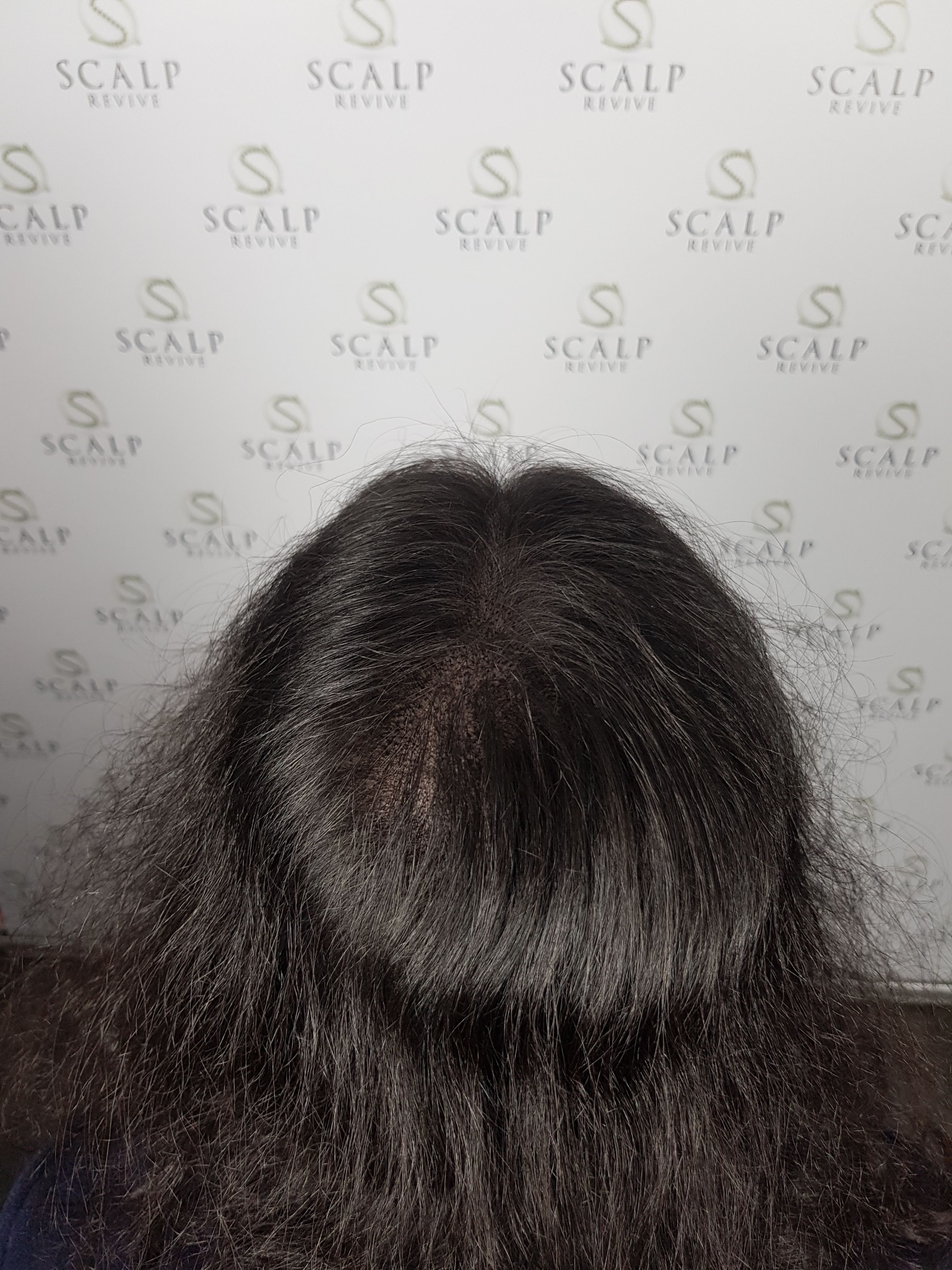 Scalp Micropigmentation for women. hair loss for women. Leeds UK