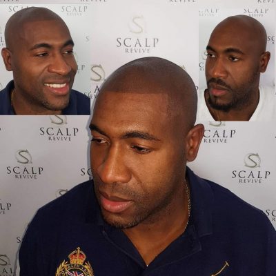 Scalp Micropigmentation Leeds, Scalp micropigmentation UK. Hair Tattoo, Leeds, UK. micropigmentation Leeds.