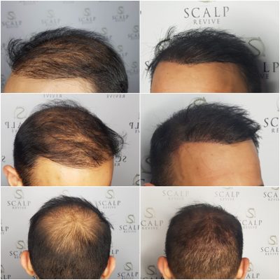 Hair Tattoo SMP densification. thinning hair in Leeds.