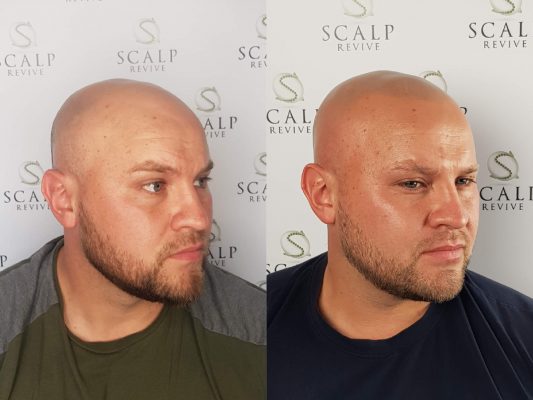 Scalp Micropigmentation Leeds. hair tattoo Leeds.