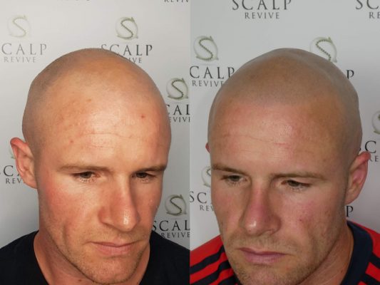 Scalp micropigmentation in Leeds. SMP Hair Tattoo in Leeds. best scalp micro clinic