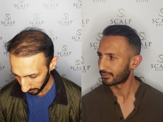 Leeds Scalp Micropigmentation, Hair transplant smp. Leeds. Scalp Uk