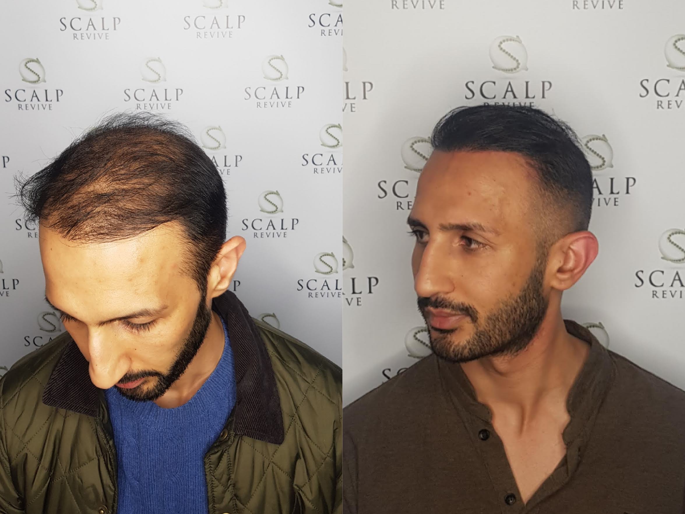 Leeds Scalp Micropigmentation, Hair transplant smp. Leeds. Scalp Uk