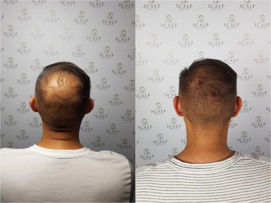 hair tattoo in Leeds. SMP Uk. Scalp Micro Pigmentation UK
