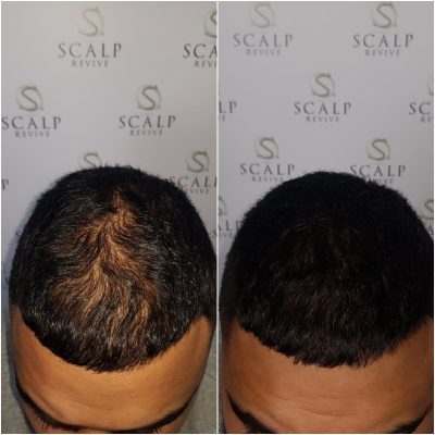 Long Hair SMP, Scalp micropigmentation UK. Hair tattoo Leeds. thinning hair Leeds