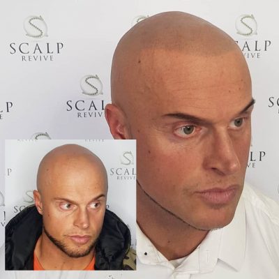 scalp leeds