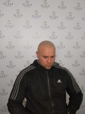 scalp leeds