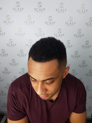 thinning hair