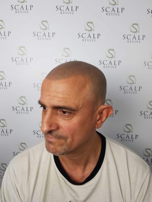 scalp micropigmentation