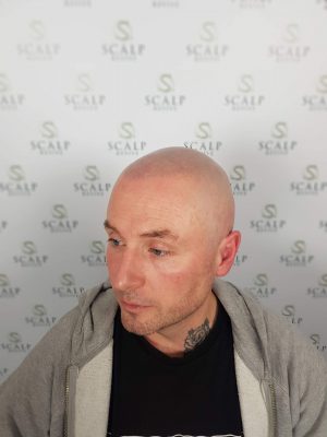 scalp micropigmentation uk
