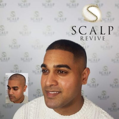 scalp micropigmentation uk