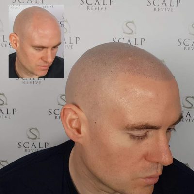 scalp micropigmentation uk