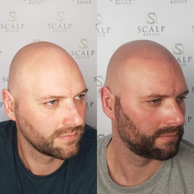 scalp leeds