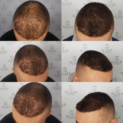 scalp leeds
