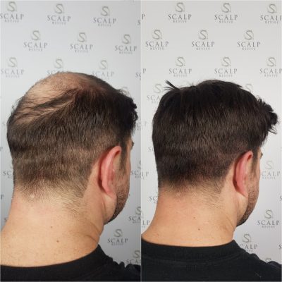 leeds scalp