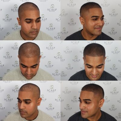 Scalp Leeds