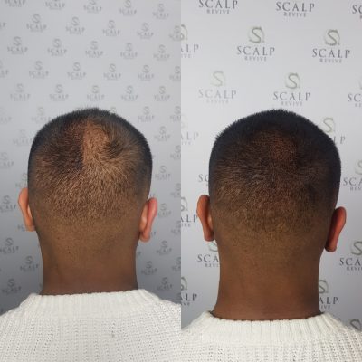 scalp micropigmentation