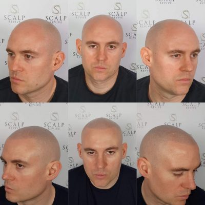 scalp tattoo leeds