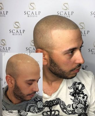scalp leeds