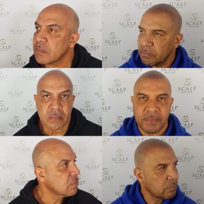 scalp micro pigmentation Leeds